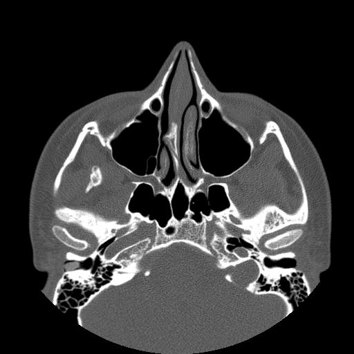 Aneurysmal bone cyst of the mandible (Radiopaedia 43280-46823 Axial bone window 143).jpg