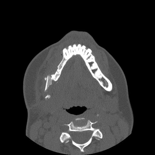 Aneurysmal bone cyst of the mandible (Radiopaedia 43280-46823 Axial bone window 44).jpg
