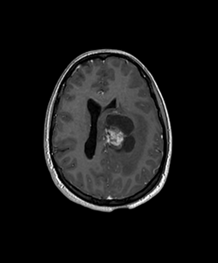 Angiomatous meningioma (Radiopaedia 79459-92577 Axial T1 C+ 3D ISO 19).jpg