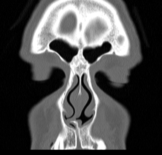 Angular epidermoid cyst (Radiopaedia 46908-51439 Coronal bone window 17).png