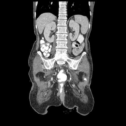 Anorectal carcinoma (Radiopaedia 44413-48064 B 59).jpg