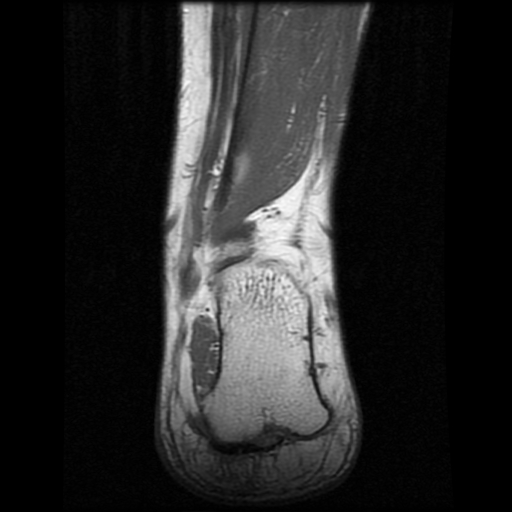 File:Anterior calcaneal process fracture (Radiopaedia 74654-85611 Coronal T1 20).jpg