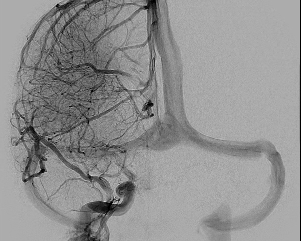 File:Anterior cerebral artery aneurysm (Radiopaedia 80683-94128 A 10).jpg