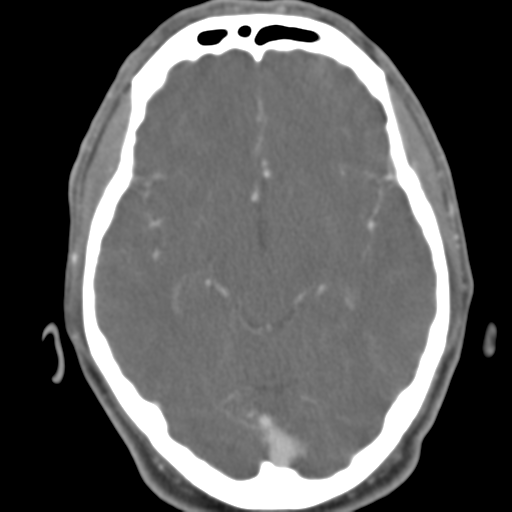Anterior cerebral artery territory infarct (Radiopaedia 39327-41581 B 34).png