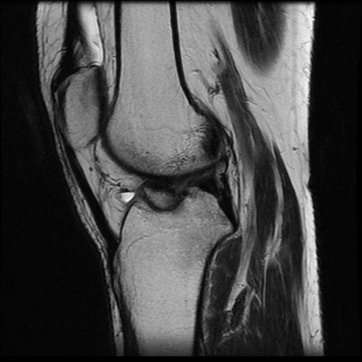 File:Anterior cruciate ligament avulsion fracture (Radiopaedia 58939-66193 Sagittal T2 10).jpg