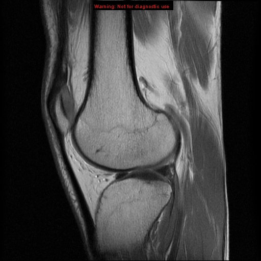 File:Anterior cruciate ligament injury - partial thickness tear (Radiopaedia 12176-12515 Sagittal PD 13).jpg