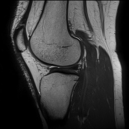 Anterior cruciate ligament rupture and posteromedial corner injury (Radiopaedia 67338-76723 Sagittal PD 111).jpg