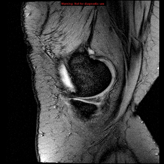 File:Anterior cruciate ligament tear (Radiopaedia 12329-12612 A 18).jpg