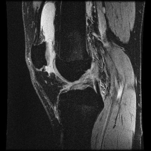 Anterior cruciate ligament tear (Radiopaedia 61500-69462 F 43).jpg
