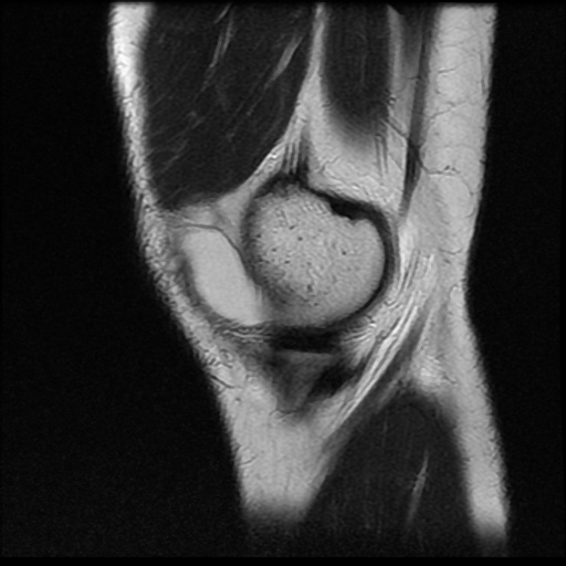 File:Anterior cruciate ligament tear (Radiopaedia 61500-69462 Sagittal T2 2).jpg