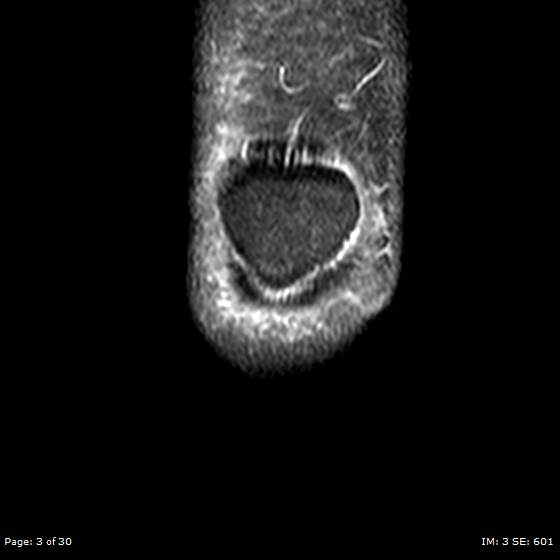 File:Anterior cruciate ligament tear (Radiopaedia 70783-80964 Coronal STIR 3).jpg