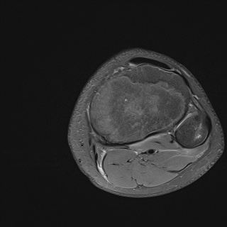 File:Anterior cruciate ligament tear - pediatric (Radiopaedia 62152-70260 Axial PD fat sat 32).jpg