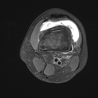 File:Anterior cruciate ligament tear - pediatric (Radiopaedia 62152-70260 Axial PD fat sat 5).jpg