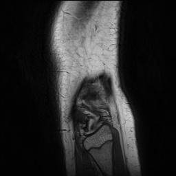 Anterior cruciate ligament tear - pediatric (Radiopaedia 62152-70260 Sagittal PD 158).jpg