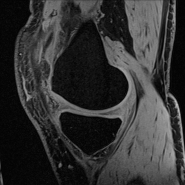 Anterior cruciate ligament tear - ramp lesion (Radiopaedia 71883-82322 Sagittal T1 vibe 99).jpg