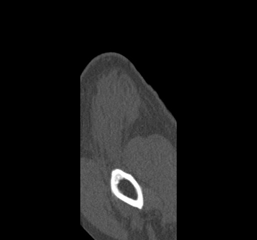 Anterior glenohumeral dislocation with Hill-Sachs lesion (Radiopaedia 62877-71249 Sagittal bone window 4).jpg