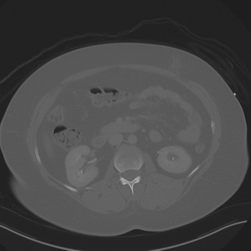 Anterior superior iliac spine avulsion fracture (Radiopaedia 44541-48244 Axial bone window 42).png