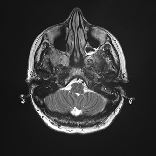 File:Anterior temporal encephalocele (Radiopaedia 82624-96808 Axial T2 5).jpg