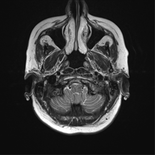 File:Anterior temporal lobe perivascular space (Radiopaedia 40946-43650 Axial T2 4).png