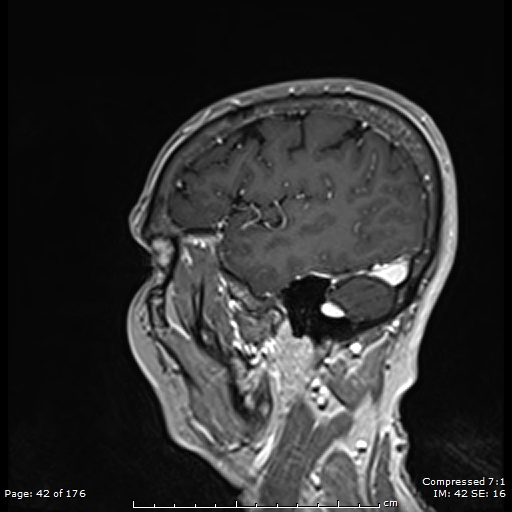 File:Anterior temporal lobe perivascular space (Radiopaedia 88283-104914 Sagittal T1 C+ 3).jpg