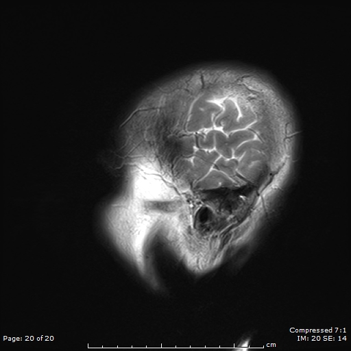 File:Anterior temporal lobe perivascular space (Radiopaedia 88283-104914 Sagittal T2 20).jpg
