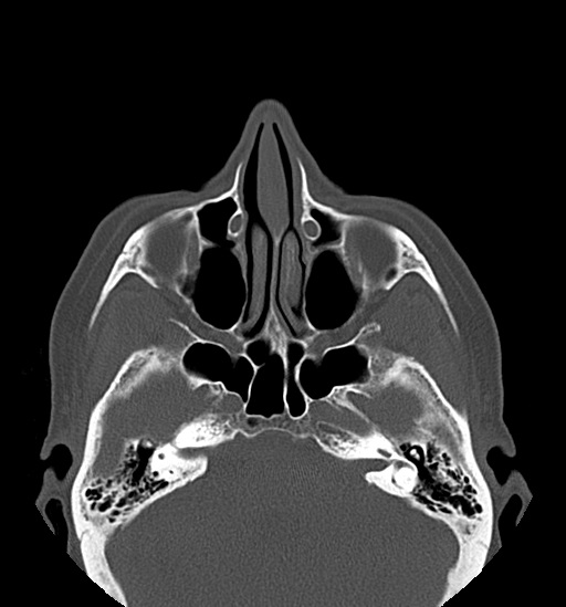 Anterior temporomandibular joint dislocation (Radiopaedia 59430-66784 Axial non-contrast 10).jpg