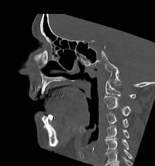Anterior temporomandibular joint dislocation (Radiopaedia 59430-66784 B 26).jpg