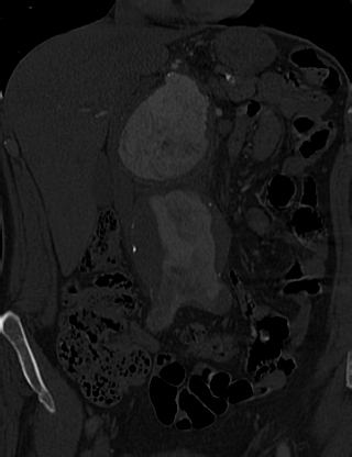 Anterior vertebral scalloping (abdominal aortic aneurysm) (Radiopaedia 66744-76067 Coronal bone window 7).jpg