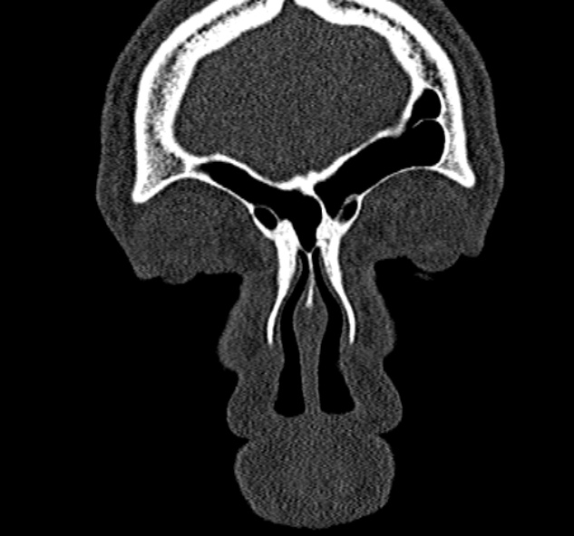 Antrochoanal polyp (Radiopaedia 30002-30554 Coronal bone window 15).jpg