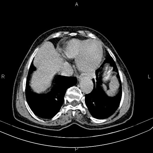 Aortic aneurysm and Lemmel syndrome (Radiopaedia 86499-102554 Axial C+ delayed 7).jpg