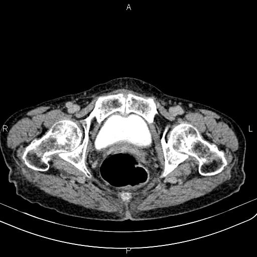 Aortic aneurysm and Lemmel syndrome (Radiopaedia 86499-102554 Axial C+ delayed 77).jpg