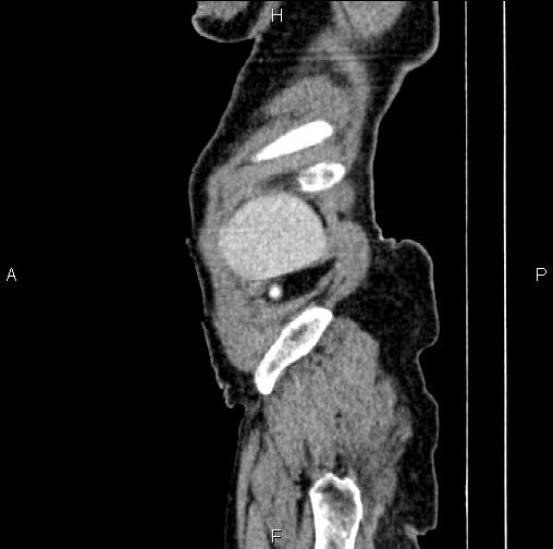File:Aortic aneurysm and Lemmel syndrome (Radiopaedia 86499-102554 D 2).jpg