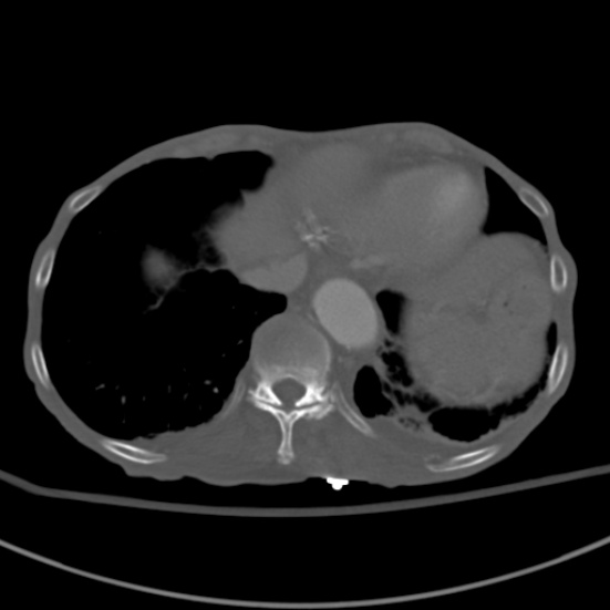 Aortic aneurysm with spinal destruction (Radiopaedia 42301-45410 Axial bone window 9).jpg