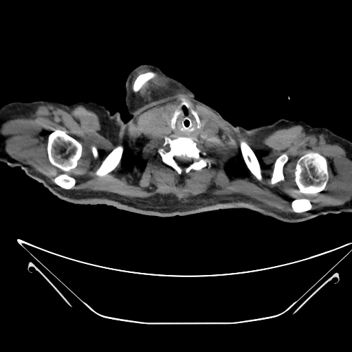 Aortic arch aneurysm (Radiopaedia 84109-99365 Axial non-contrast 3).jpg