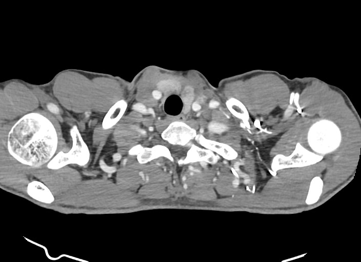File:Aortic coarctation with aneurysm (Radiopaedia 74818-85828 A 183).jpg