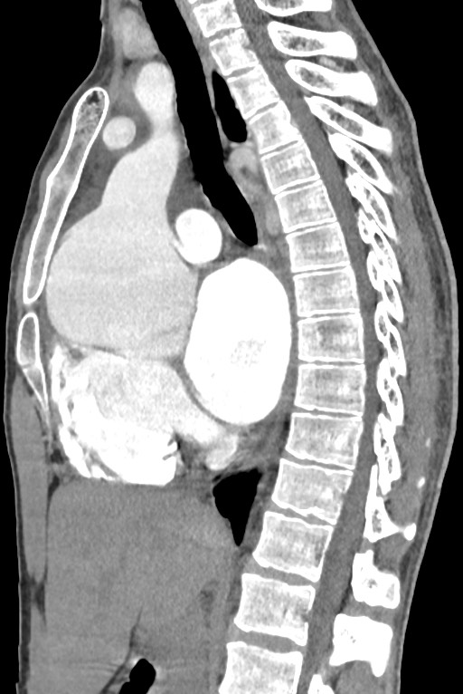Aortic coarctation with aneurysm (Radiopaedia 74818-85828 B 82).jpg