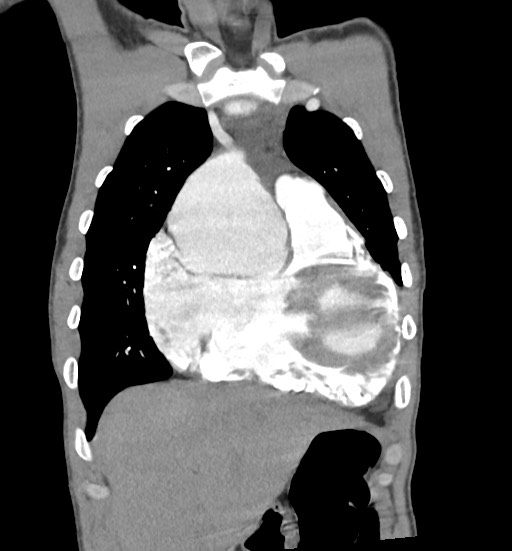 Aortic coarctation with aneurysm (Radiopaedia 74818-85828 C 29).jpg