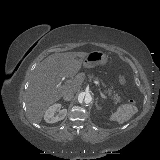 Aortic dissection- Stanford A (Radiopaedia 35729-37268 B 42).jpg