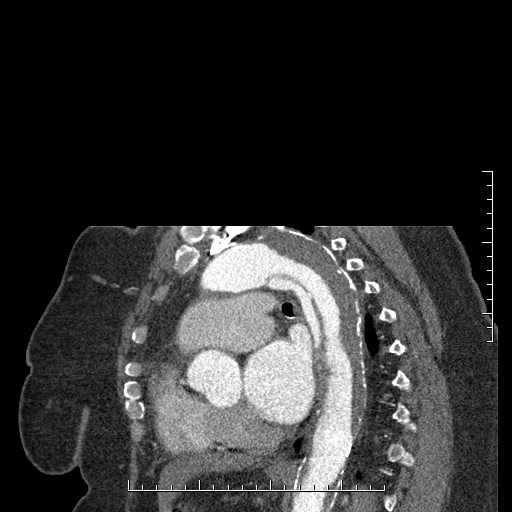 File:Aortic dissection- Stanford A (Radiopaedia 35729-37268 D 17).jpg