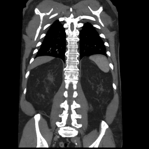 File:Aortic dissection- Stanford A (Radiopaedia 37759-39664 Coronal C+ delayed 42).png