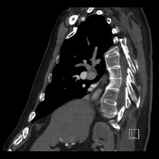 File:Aortic dissection (CTPA) (Radiopaedia 75506-86750 C 37).jpg