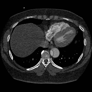 Aortic dissection (Radiopaedia 57969-64959 A 226).jpg