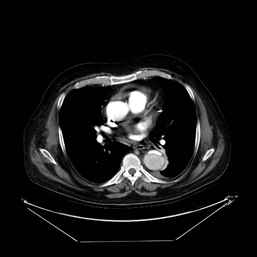 Aortic dissection (Radiopaedia 62562-71000 A 20).jpg