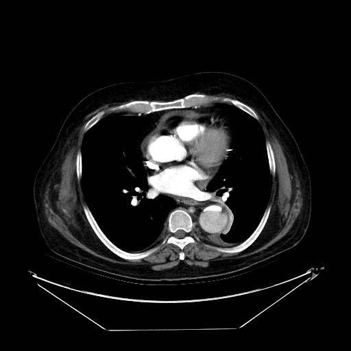 Aortic dissection (Radiopaedia 62562-71000 A 23).jpg