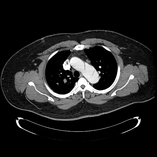 File:Aortic dissection (Radiopaedia 7687-8505 A 1).jpg