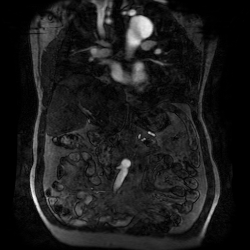 File:Aortic dissection - Stanford A - DeBakey I (Radiopaedia 23469-23551 D 110).jpg