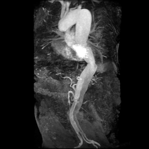 File:Aortic dissection - Stanford A - DeBakey I (Radiopaedia 23469-23551 MRA 23).jpg