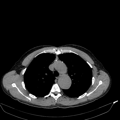 Aortic dissection - Stanford type A (Radiopaedia 83418-98500 Axial non-contrast 13).jpg