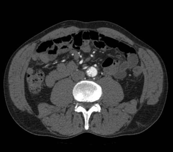 Aortic dissection - Stanford type B (Radiopaedia 73648-84437 A 178).jpg