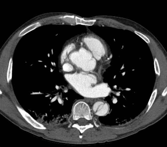 Aortic dissection - Stanford type B (Radiopaedia 73648-84437 A 60).jpg